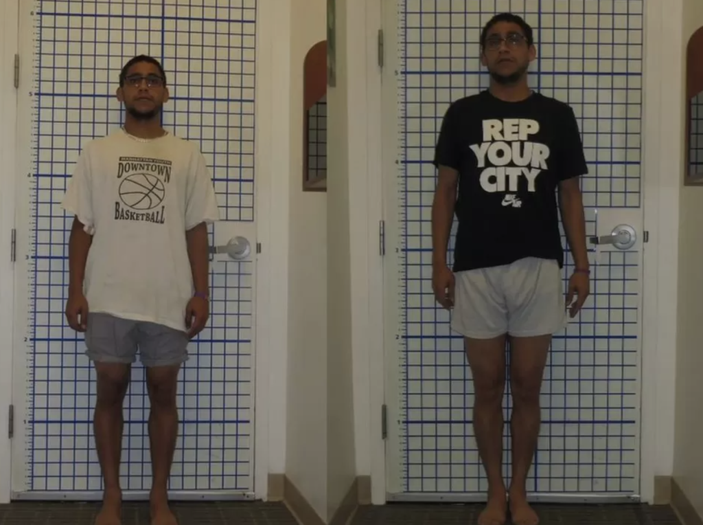 What Men Are Doing To Try To Become Taller Is Absolutely Gruesome….